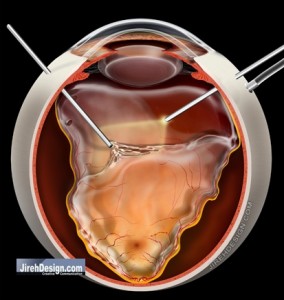 A Vitrectomy Can Fix a Retinal Detachment