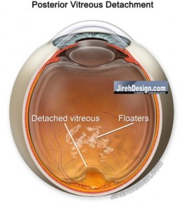 Posterior Vitreous Detachment "Separates" from the Retinal Surface