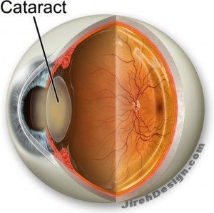 Cataracts Cause Decreased Vision