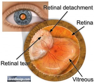 Retinal Detachment Threatening the Macula